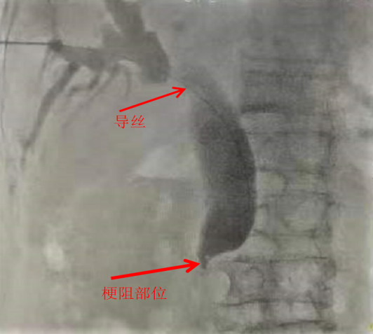 PTCD引流步驟1.png