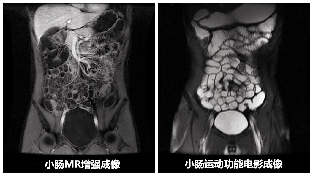 小腸MR增強(qiáng)成像_副本.jpg